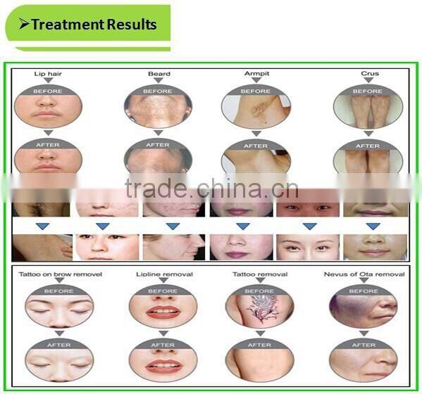 Super combination, Multi-function machine, Laser SHR IPL epila laser hair remover