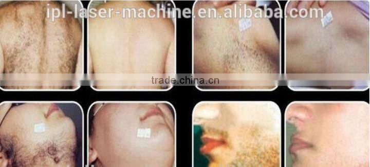 big spot size fast hair removal ipl beauty equipment for sale