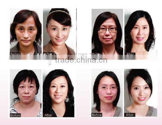 hotest freckles removal skin care bipolar rf