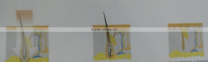 810NM DIODES LASER HAIR REMOVAL machine