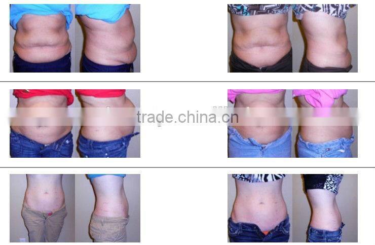 Alibaba China Suppier rf face lift machine photon ultrasonic device cavitation rf machine,New face NV-i3