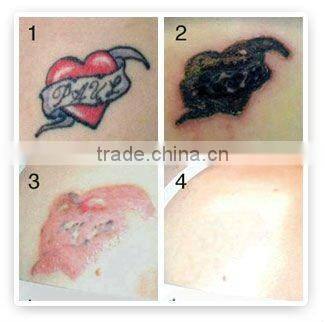 Temporary removal Tattoo products-Q Switched Nd 1064nm yag Laser D001
