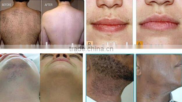 2016 Newest Diode Laser 808nm permanant hair removal and skin rejuvenation machine