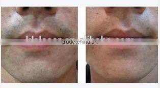 New arrival Germany Bars diode laser 808 hair remover feature for permanent hair removal