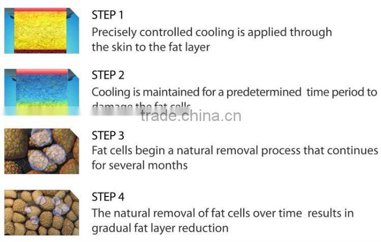 Most popular medical slimming cryogenic liposuction, cryogenic lipolysis