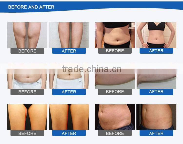 Factory direct sales fat freezing best cryolipolysis machine with better result