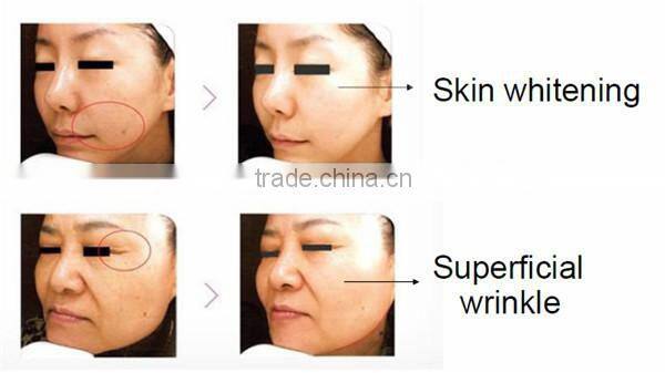 2015 hot selling radiofrecuencia rf portable equipment