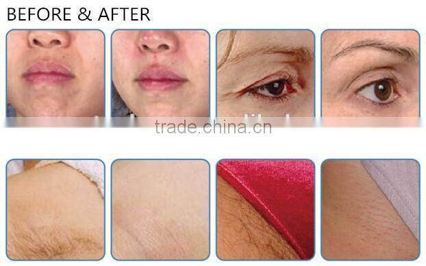 Super hair removal SHR+ HIFRF radio frequency aesthetics