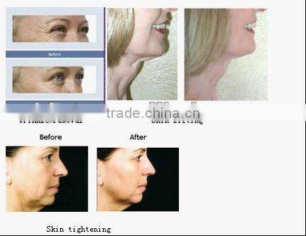 2014 hot sales Multi-polar RF beauty machine