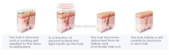 Y9D-Ydel laser diode 808nm without pain / factory price cheap 808 nm diode laser hair removal