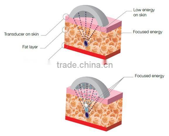 fat reduce hifu ultrason cavitation body slimming machine cellulite machine
