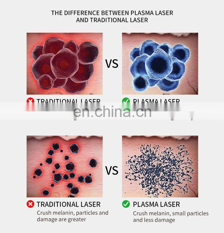 Non-invasive Painless Ozone Plasma Pen Laser Skintag Remove Machine 2 IN 1 Spot Acne Scar Wrinkle Removal Beauty Instrument