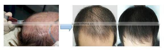 Patent PRP tube in China