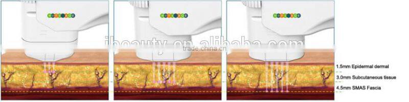 2015 Most Popular Lift Eyes&Brows Remove Crows Feet & Pouches High Intensity Focused Ultrasound Hifu