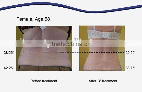vacuum/ cavitation / RF / Laser fat system / slimming equipment LS650