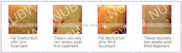 hifu body lift multifunction slimming beauty machine