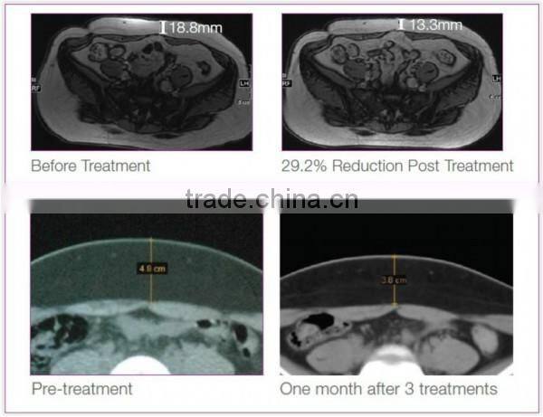 HIFU body shaping machine for weight loss centre