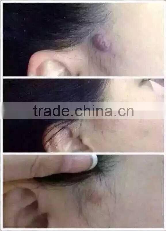 High Frequency Spot Removal Pen speckle removal