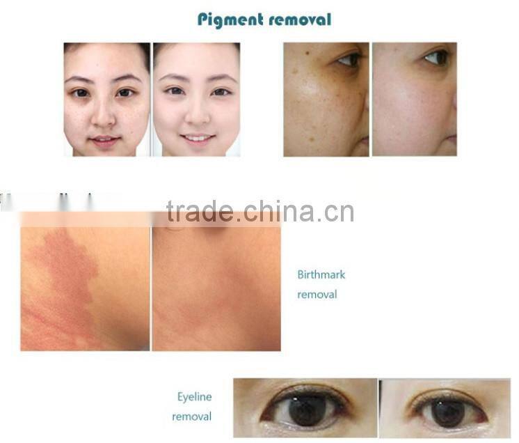 high quality q switch nd yag laser device for effective tattoo removal