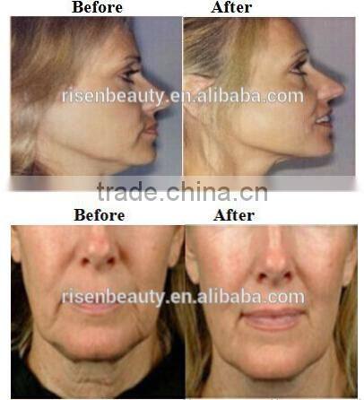 2014 Latest and hottest thermagic skin tighten