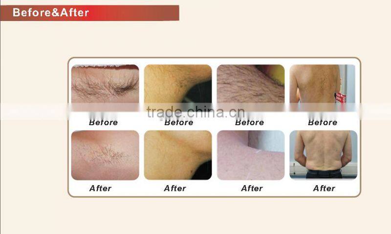 Laser Hair Epilation Diode Laser