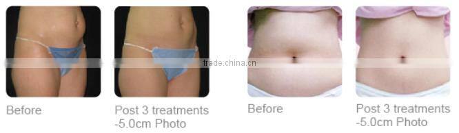 Hot sale! high frequency focused ultrasound roller lipo cavitation machine for full body slim