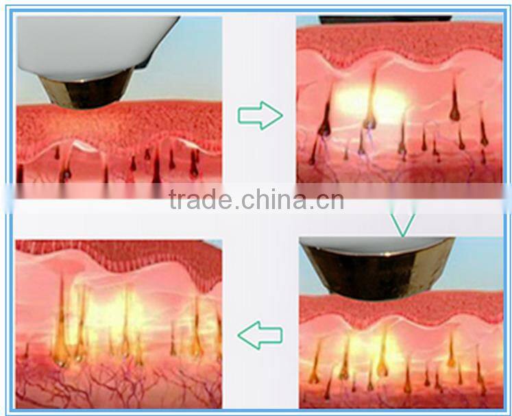 Best selling products laser diodo 810nm depilation