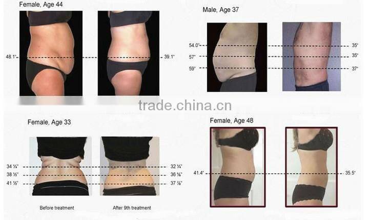 Portable 2 in 1 Cryolipolysis Fat Freeze Cellulite therapy Machine with Vacuum RF Roller skin tighten and weight loss machine