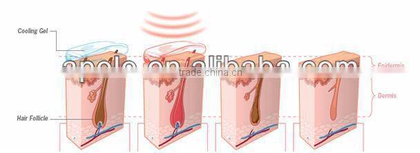 OPT beauty system Apolomed HS300C e-light ipl rf nd yag laser multifunction machine