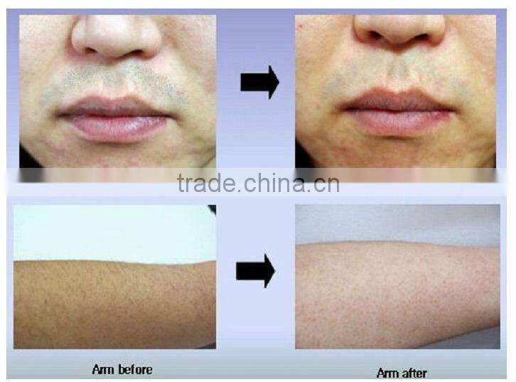 Hot 2014 Newest smart lumenis lightsheer diode laser/808nm diode laser hair removal machine