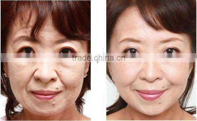 540 needles Microneedle derma roller Improve skin and delicate L005