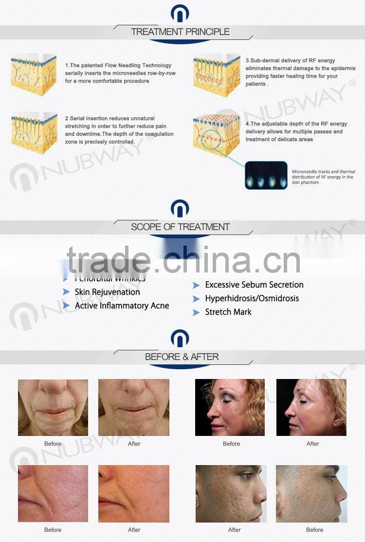 Fractional RF microneedle skin care machine portable fractional rf machine