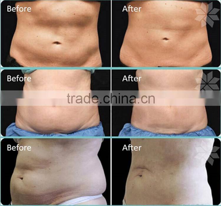 5 in1 40k cavitation ultrasonic rf radio cavitadora ultrasonic cavi slimming machine