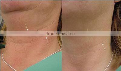 The best rf lifting machine for salon use TRF-02