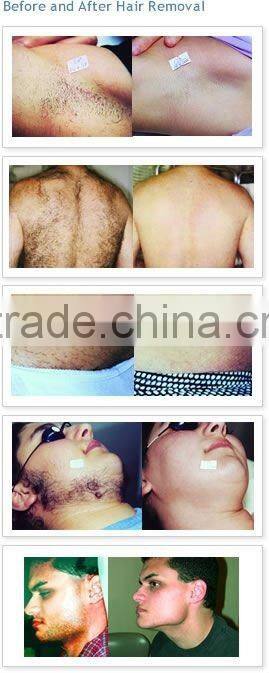 KES Medical CE Painfree 808nm laser hair removal machine diode