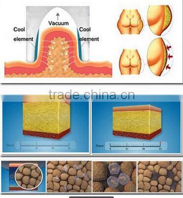 BD06A beauty machine 10m rf cocoon beauty tighten cryo therapy system cryo