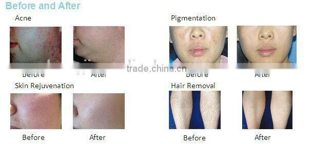 Medical ce approval fractional co2 laser portable medical /fractional co2 laser mini