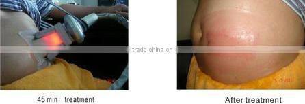 salon cryolipolysis bipolar tripolar rf vacuum cellulite ultrasonic