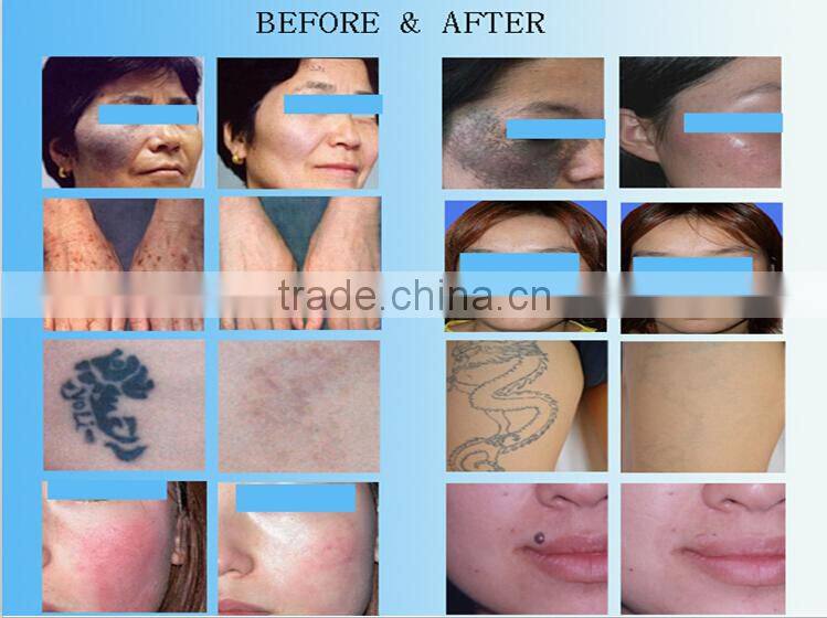 q switched nd yag tattoo removal and wrinkle remover laser machine with 7 joind light guiding arm