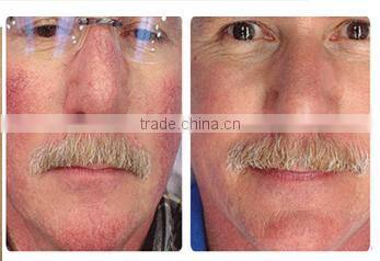 professional diode laser blood vessels removal spider vein / vascular removal equipment