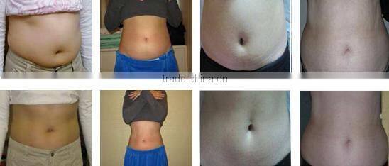 NEWS! Sales Promotion professtional 2 hand pieces Cryolipolysis cryo liposuction machine