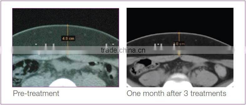 Newest High Intensity focused ultrasound hifu therapy hifushape HIfu slimming