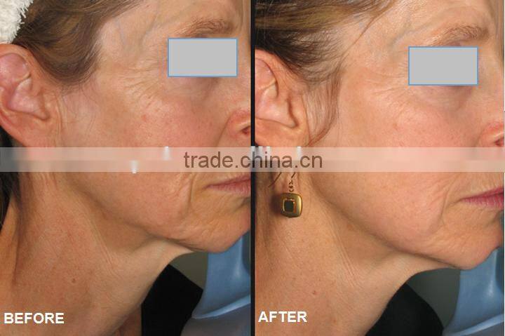 Apolomed radio frequency ceramic RF monopolar and cavitation for wrinkle and fat removal