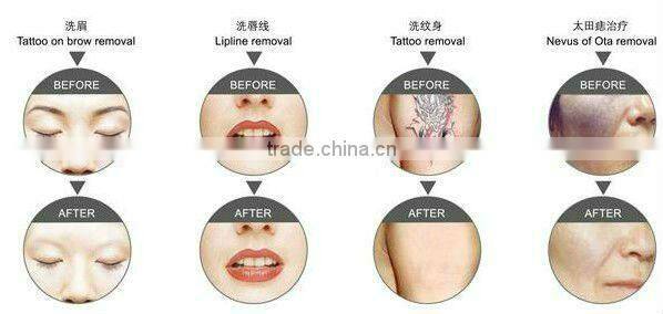 equipment for the small business :laser tattoo removal machine price D003