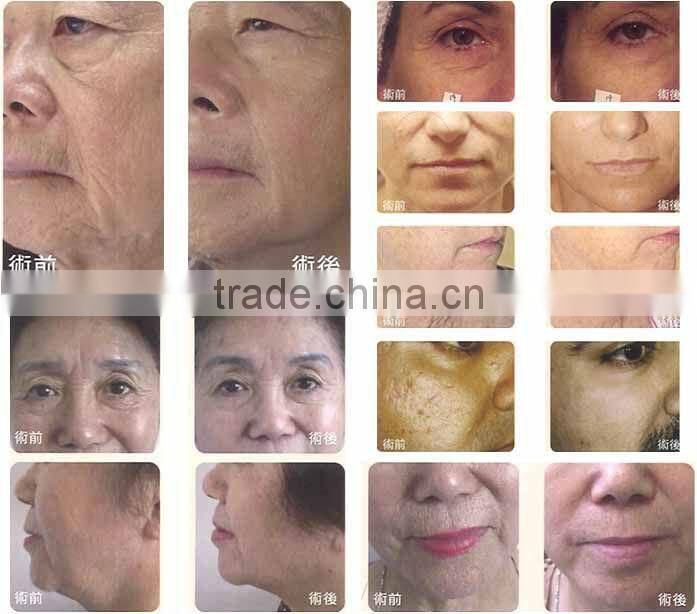 VY-QF8 Popular radio frequency facial machine for skin tightening