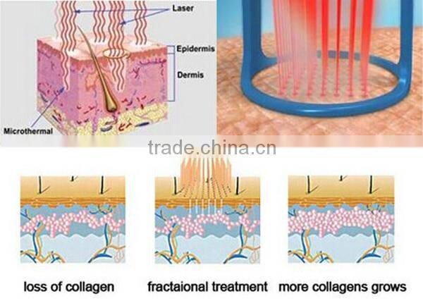 Fractional Co2 Laser for skin rejuvenation beauty equipment