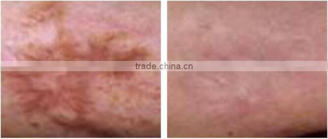 Medical ce approval fractional co2 laser portable medical /fractional co2 laser mini