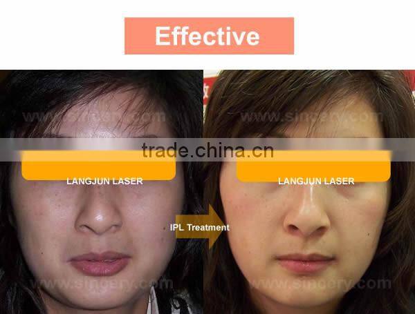 ipl laser hair removal machine made in China