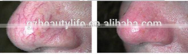 2016 High Frequency Vascular laser vein remove/ 980nm spider vascular remove
