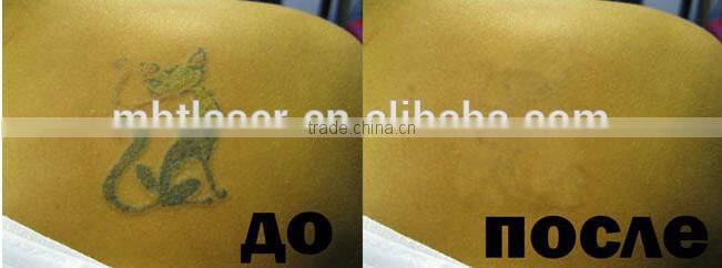 Q-Switched Nd:Yag Laser Tattoo Removal / Professional Laser Tattoo Removal Machine For Sale / Beijing